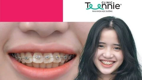 Niềng răng mắc cài sứ cần lưu ý những gì?