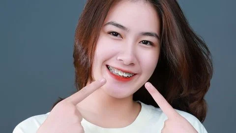 Răng hô: Nên niềng răng hay phủ sứ thẩm mỹ?