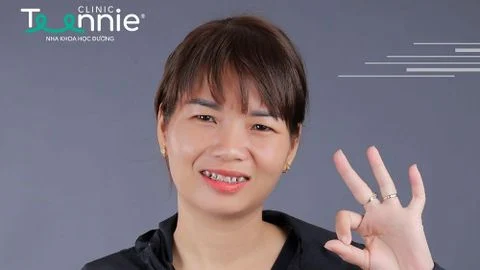 Răng cửa thưa do đâu? Niềng răng có cải thiện không?