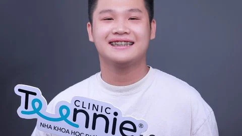 Bao nhiêu tuổi thì không nên niềng răng?