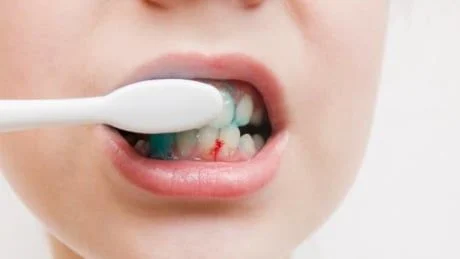 Chảy máu khi đánh răng: Coi chừng gan nhiễm mỡ!