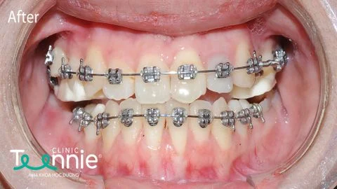 Có những khí cụ niềng răng mắc cài kim loại nào?