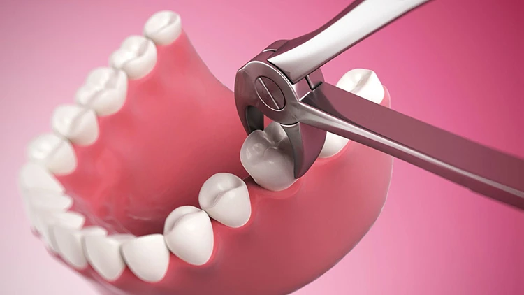 Tháng cô hồn có nên nhổ răng hay không