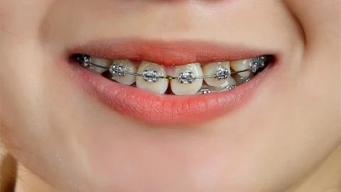 4 lưu ý quan trọng trước khi niềng răng thẩm mỹ