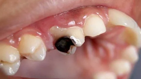 Cách ngăn ngừa tình trạng sâu răng hiệu quả
