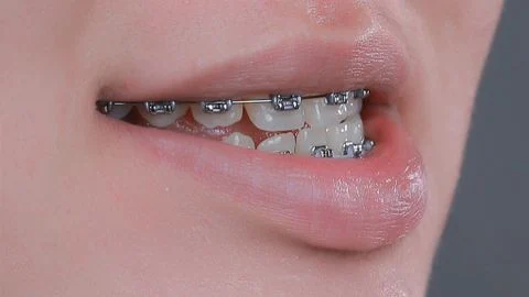 Răng móm: Khi niềng có cần nhổ bỏ hay không?