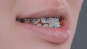 Niềng răng có làm thay đổi khuôn mặt không?