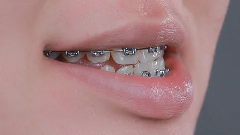 Niềng răng có làm thay đổi khuôn mặt không?