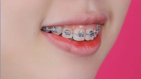 Niềng răng xong vẫn xấu, do đâu vì ai?
