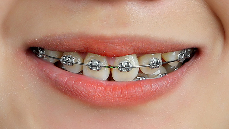 cac loai nieng rang