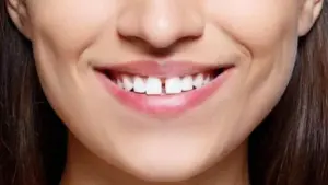 Những điểm nổi bật của trám răng thưa