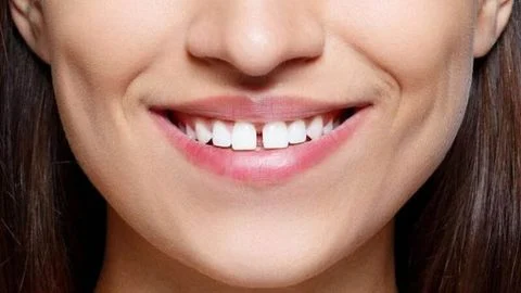 Những điểm nổi bật của trám răng thưa