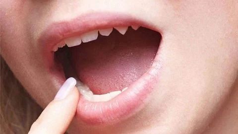 Những điều cần biết về nhiệt miệng ở má trong