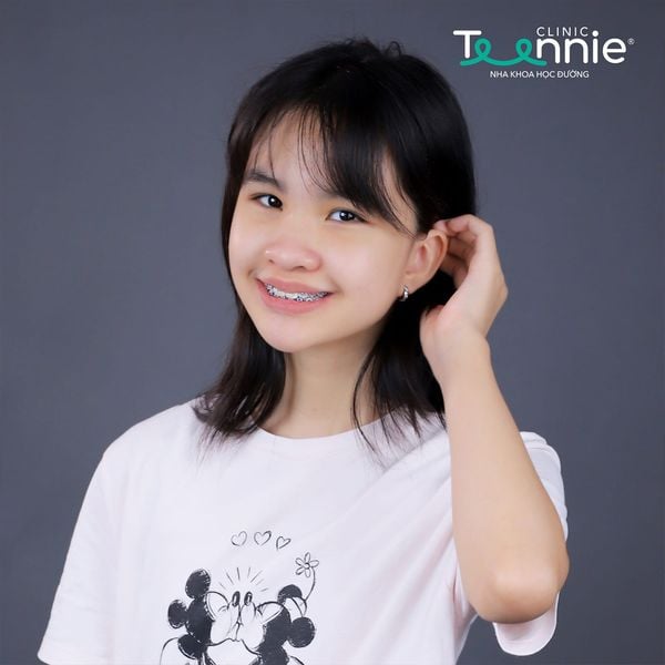 4 nguyên nhân gây ra hiện tượng nghiến răng