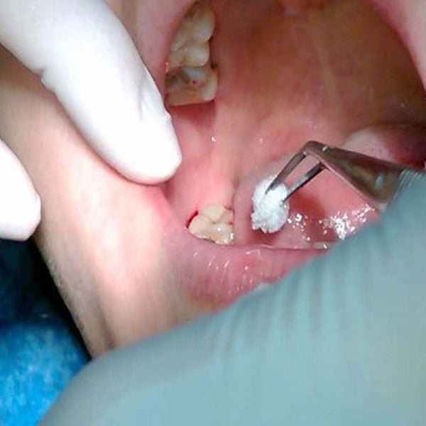 6 nguyên nhân gây màng trắng sau nhổ răng