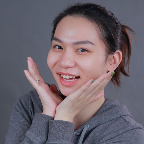 7 bước quan trọng khi trám răng cửa bị sâu