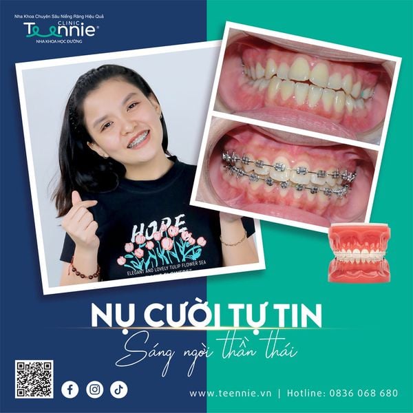 8 tác hại của niềng răng không đúng cách