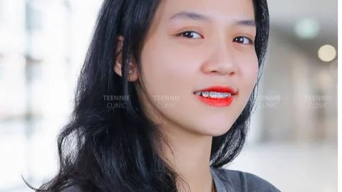 Bảng giá niềng răng cho trẻ từ 9-20 tuổi