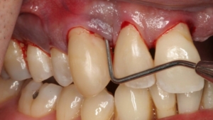 Bệnh nha chu là gì? Phòng ngừa và điều trị ra sao?