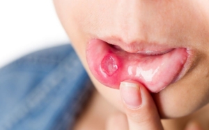 Bí quyết điều trị nhiệt miệng bằng nước muối pha loãng