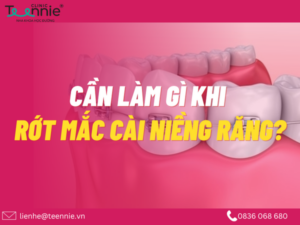 Bị rớt mắc cài khi niềng răng thì phải làm sao? Nguyên nhân do đâu?