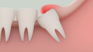 Biến chứng do áp xe răng khôn nguy hiểm thế nào?