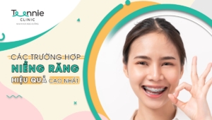 Các trường hợp niềng răng mang lại hiệu quả cao nhất cho nụ cười xinh