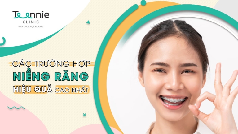 Các trường hợp niềng răng mang lại hiệu quả cao nhất cho nụ cười xinh