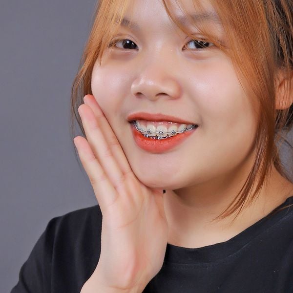 Cách điều trị răng cửa bị sâu nhẹ