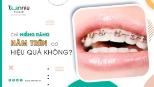 Chỉ niềng răng hàm trên có hiệu quả không?