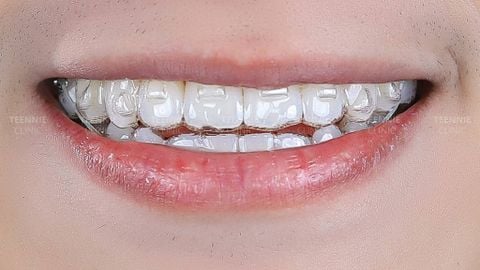Có nên niềng răng trong suốt cho bé không?