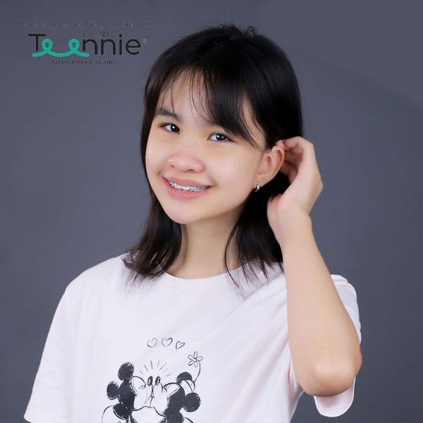 Điều trị tủy răng sữa cho trẻ như thế nào?