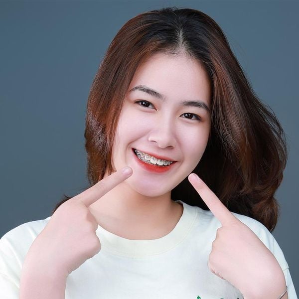 Độ tuổi lý tưởng để niềng răng thẩm mỹ