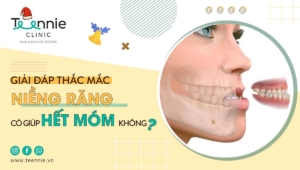 Giải đáp thắc mắc niềng răng có giúp hết móm không?