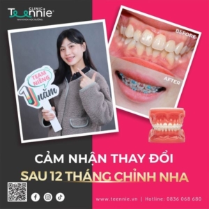Khắc phục tình trạng hôi miệng khi niềng răng
