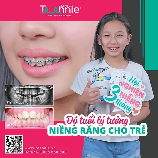 Niềng răng thẩm mỹ