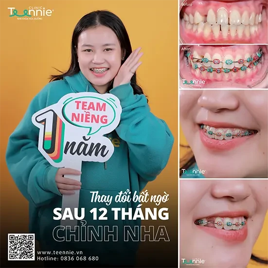 Niềng răng thẩm mỹ