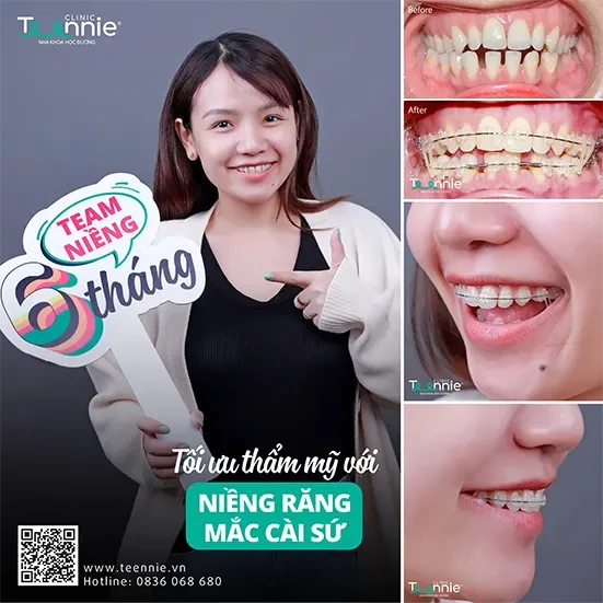 Niềng răng thẩm mỹ