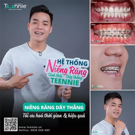 Niềng răng thẩm mỹ