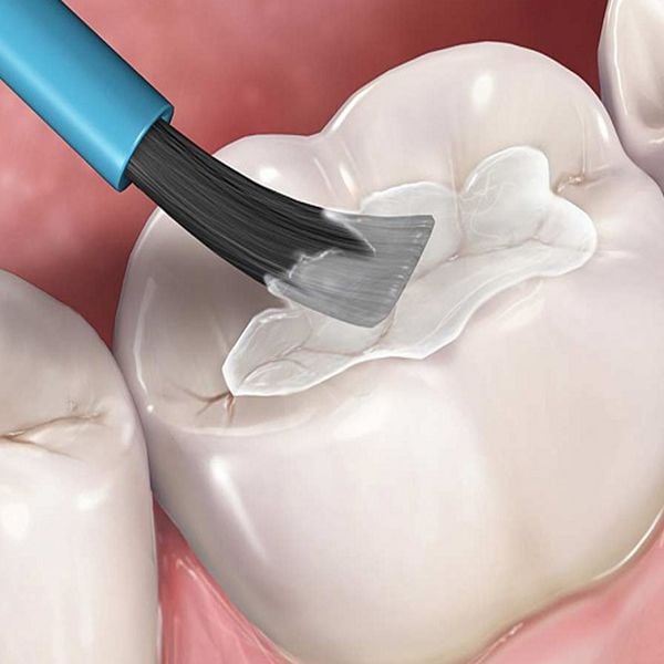 Khi trám răng cần lưu ý những gì?