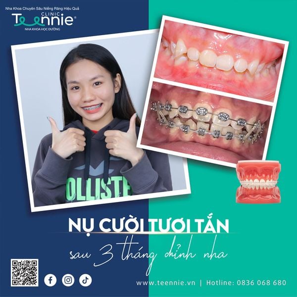 Làm răng sâu tự rụng gây hại như thế nào?