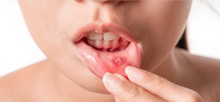 Nhiệt miệng: Chớ lo vì đã có những loại trái cây này!
