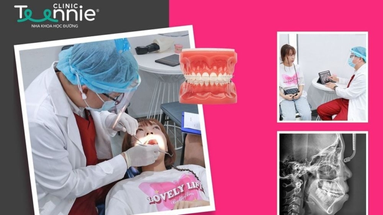 Nhổ răng bao lâu có thể ăn uống như bình thường?