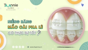 Những điều cần biết về niềng răng mắc cài pha lê!