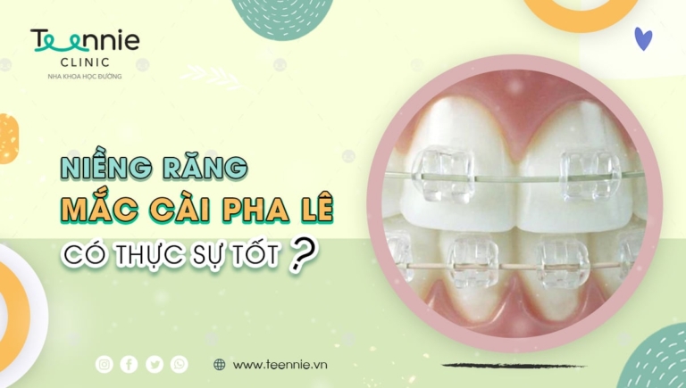 Những điều cần biết về niềng răng mắc cài pha lê!