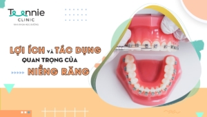 Những lợi ích và tác dụng quan trọng của niềng răng
