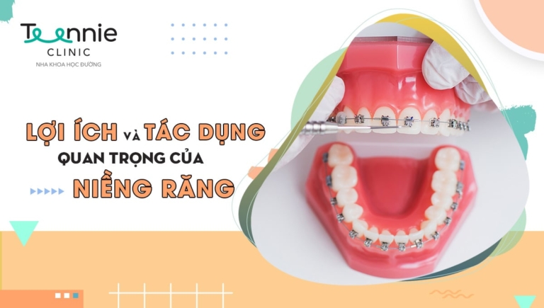 Những lợi ích và tác dụng quan trọng của niềng răng