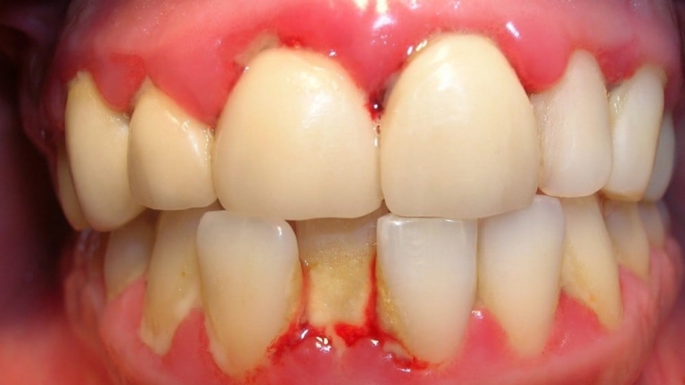 Những nguy hiểm khó lường của bệnh nha chu