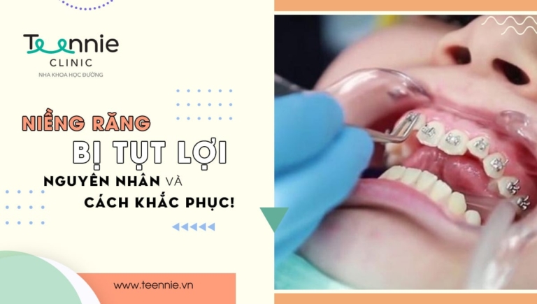 Niềng răng bị tụt lợi: Nguyên nhân và cách khắc phục!