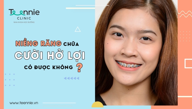 Niềng răng chữa cười hở lợi có được không?